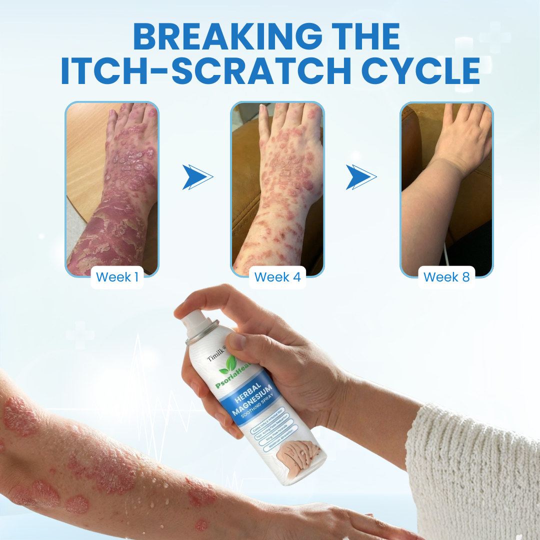 Timilk® PsoriaHeal Herbal Magnesium Soothing Spray