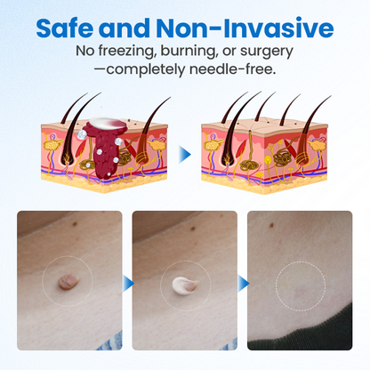 Timilk® TagGone Wart Removal Cream 🔥